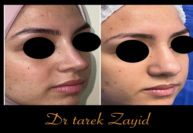   أسئلة عن عملية تجميل الأنف بعد وقبل 